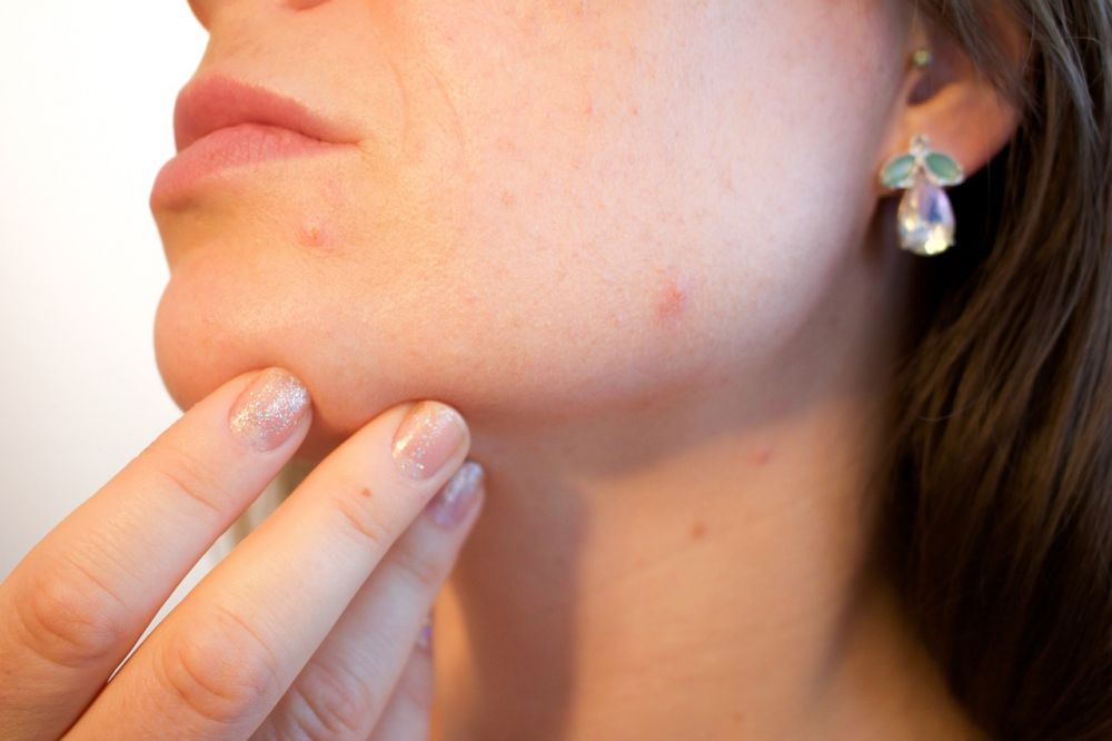 Aknebehandling: Veien til sunn hud